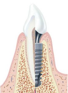 implantes Dentales
