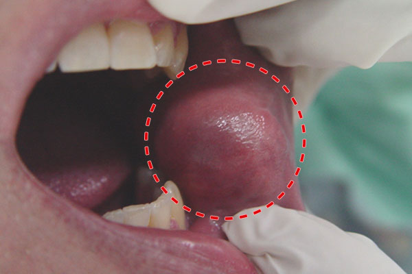 patologia oral no maligna